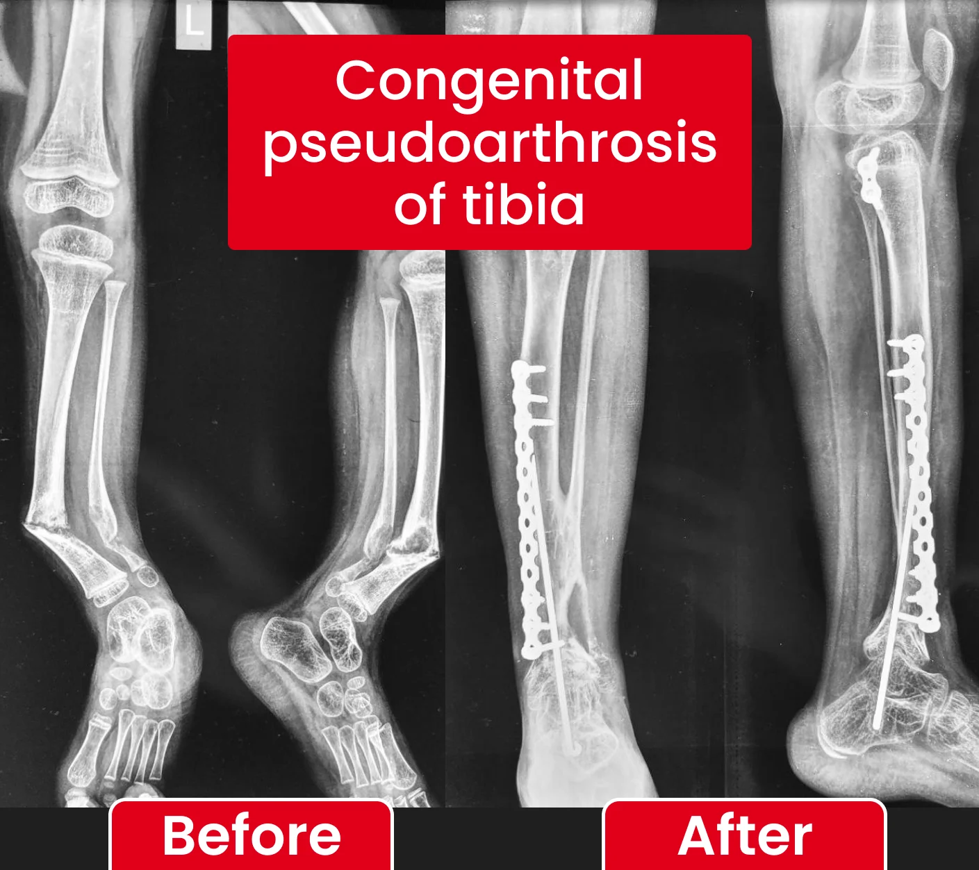 Congenital pseudoarthrosis of tibia