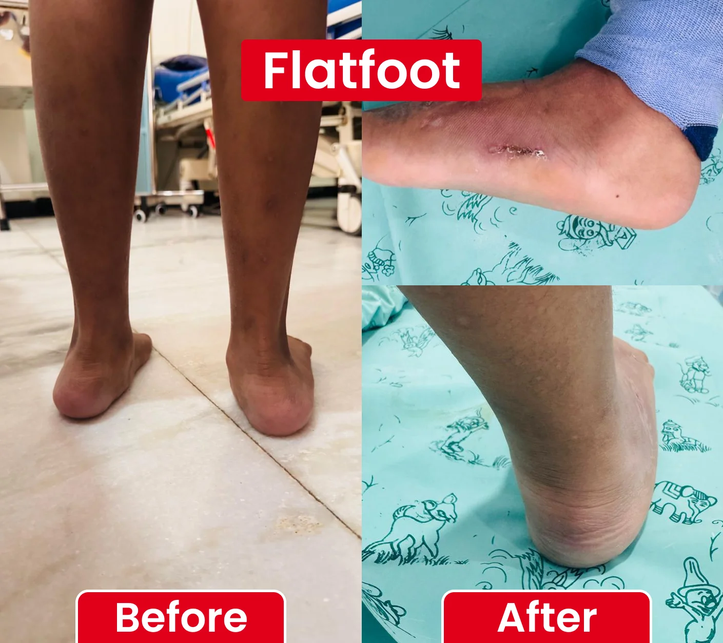 Flatfoot