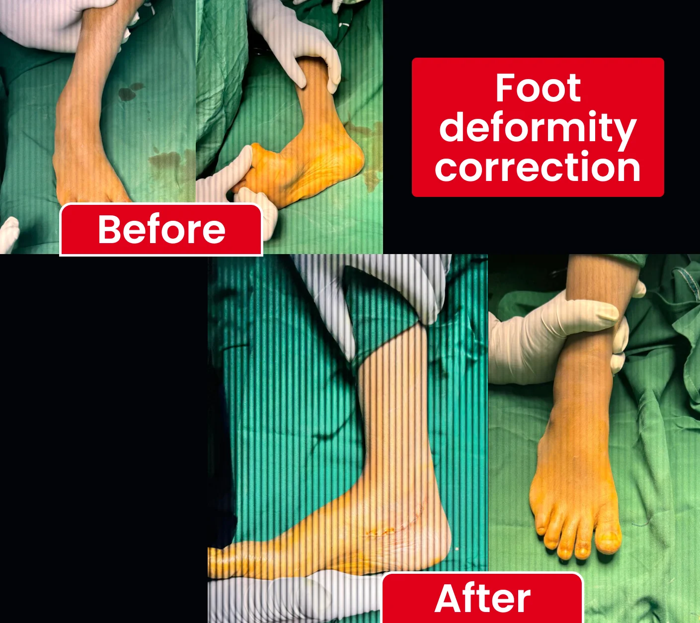 Foot deformity correction