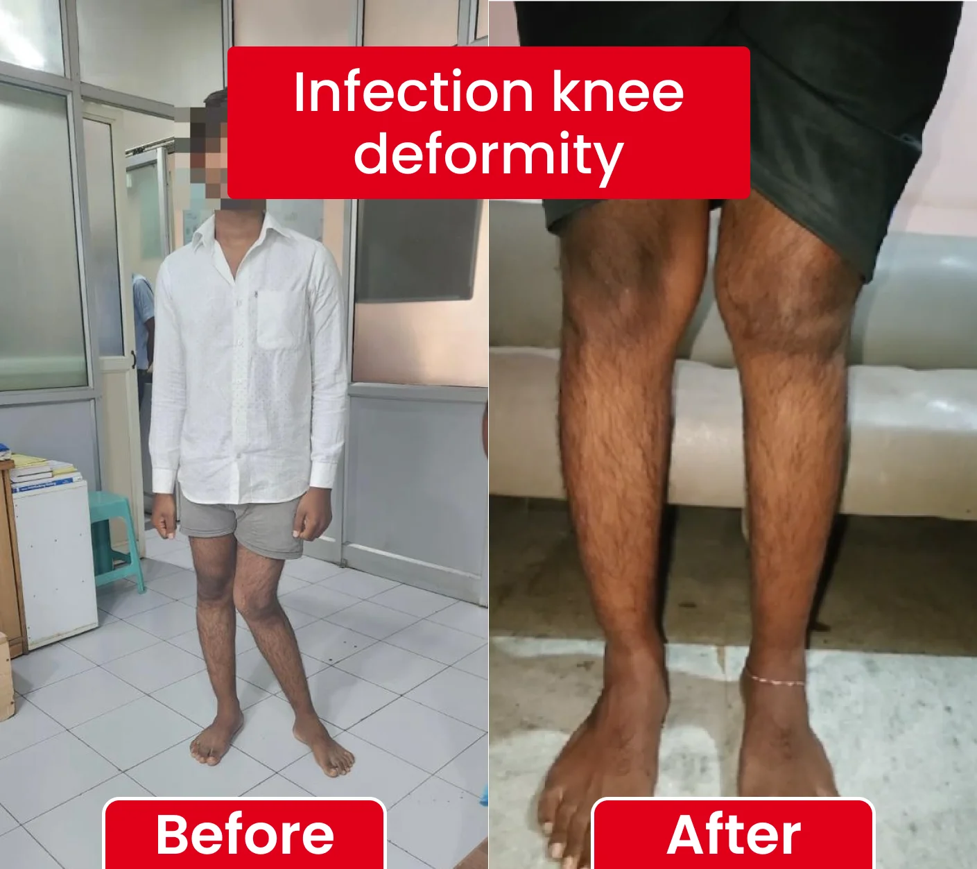 Infection knee deformity