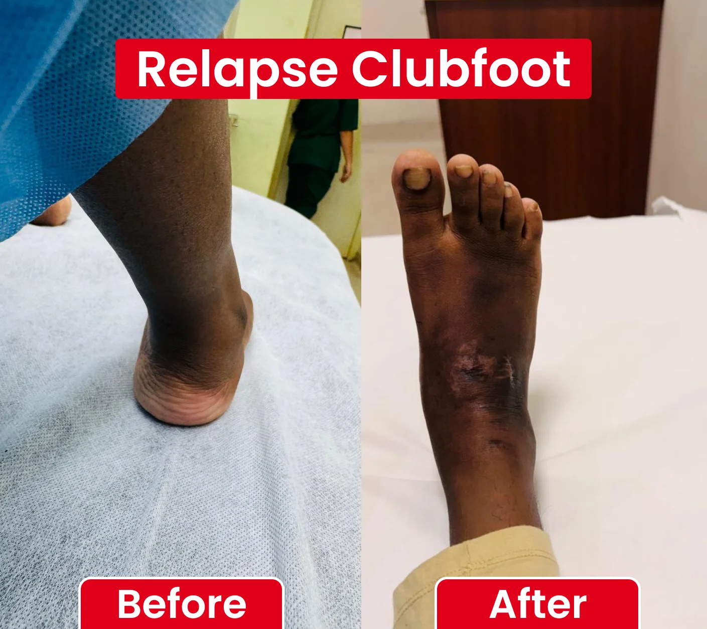 Relapse Clubfoot
