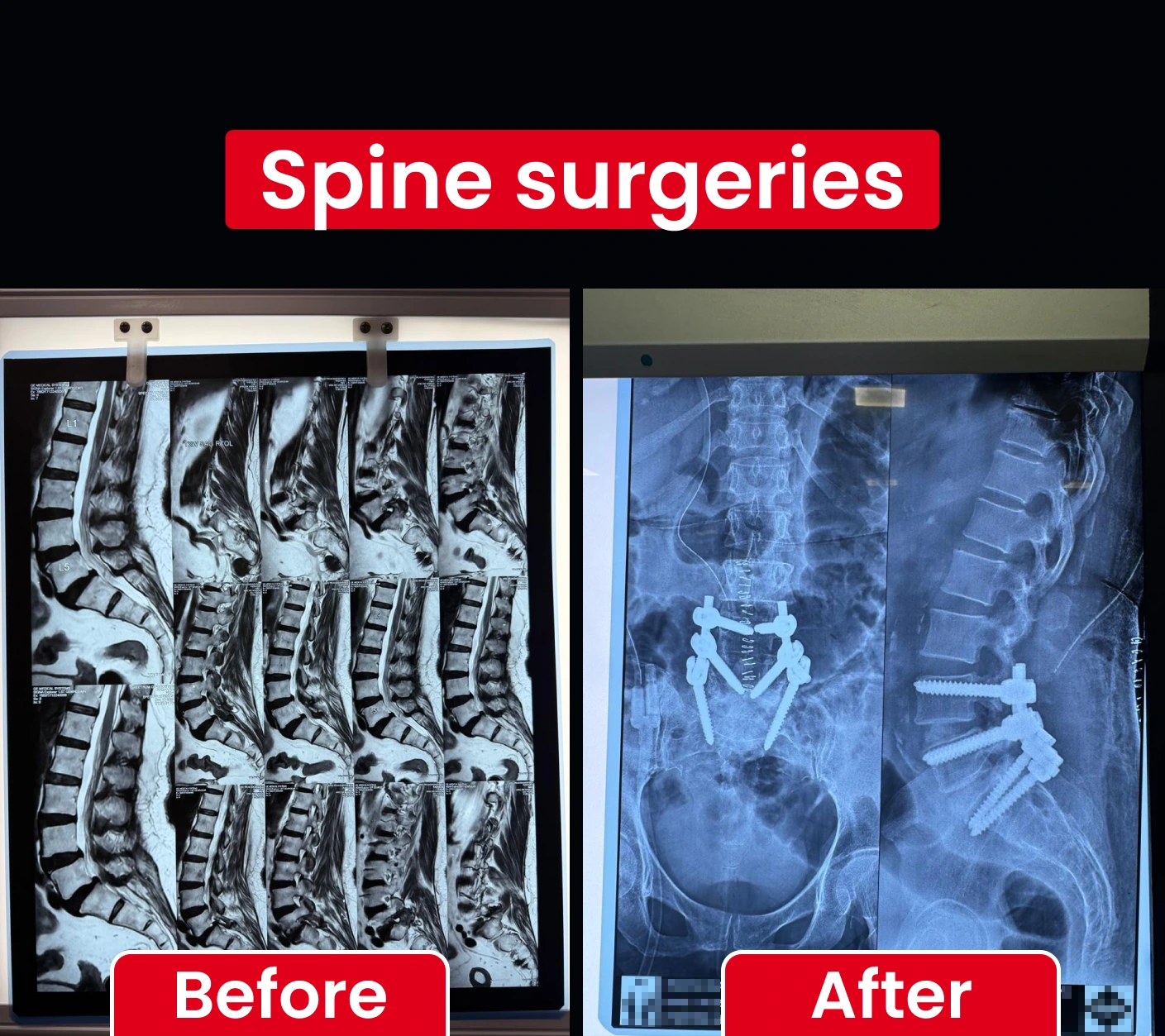 Spine surgeries