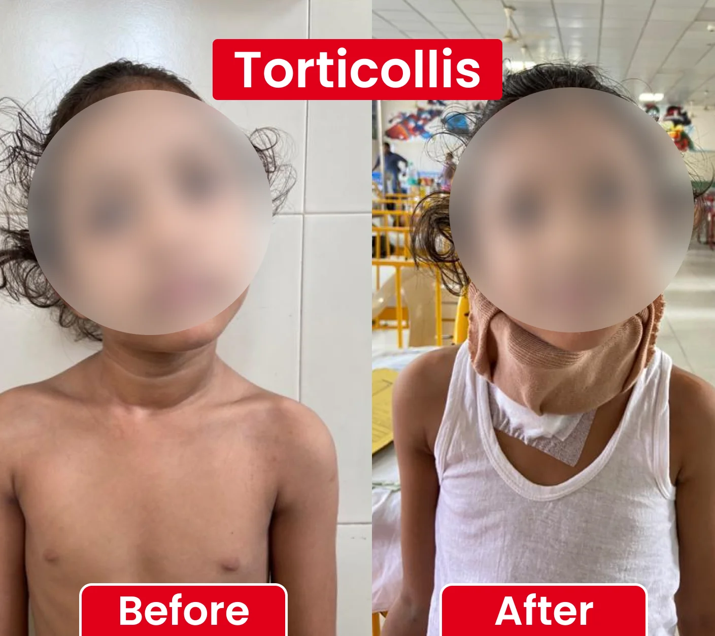 Torticollis