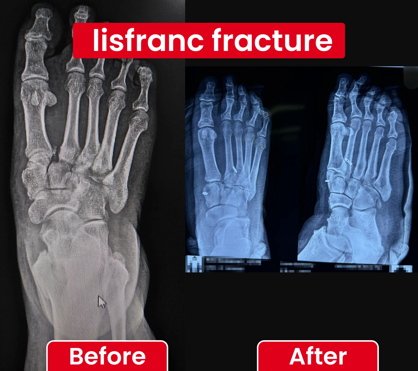 lisfranc fracture